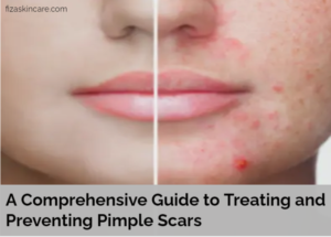 Pimple Scars
