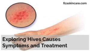 Exploring Hives Causes Symptoms and Treatment