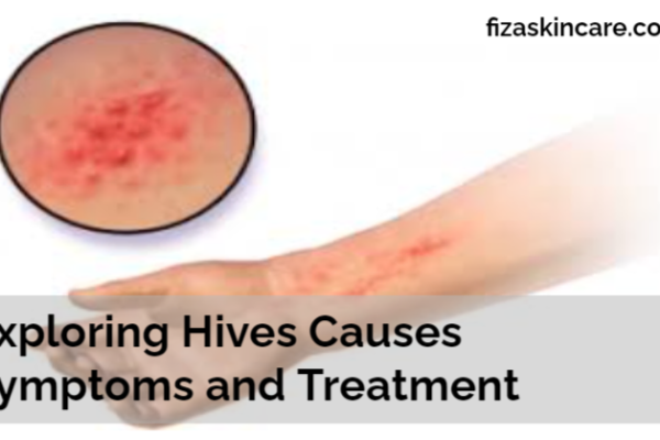 Exploring Hives Causes Symptoms and Treatment