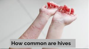 How common are hives