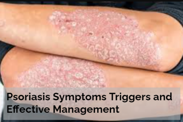 Psoriasis Symptoms