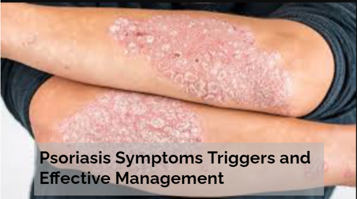 Psoriasis Symptoms